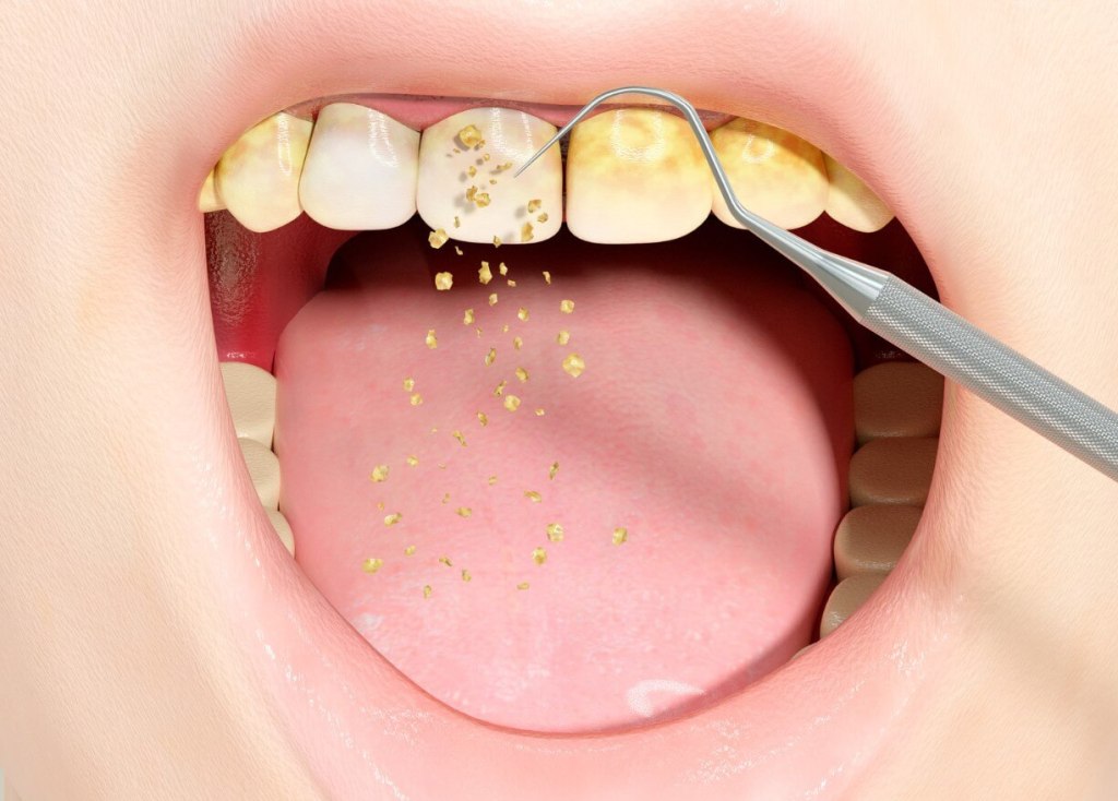 How to Clean Teeth and Remove&nbsp;Plaque