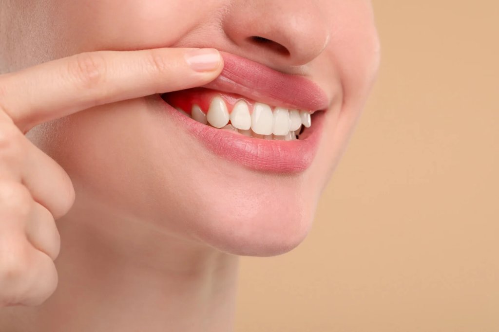 What Is Gum Disease and How Is It Treated